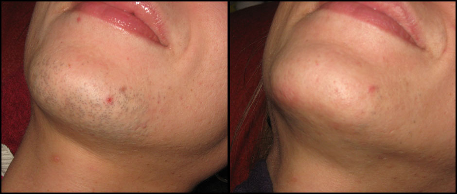 Dlake na bradi forum